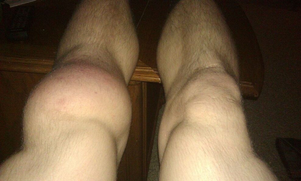 koljena prije tretmana Osteflexom